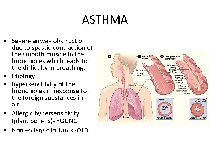 ASTHMA • Severe airway obstruction due to spastic contraction of the smooth muscle in