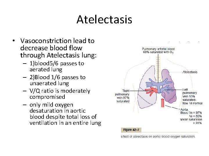 Atelectasis • Vasoconstriction lead to decrease blood flow through Atelectasis lung: – 1)blood 5/6