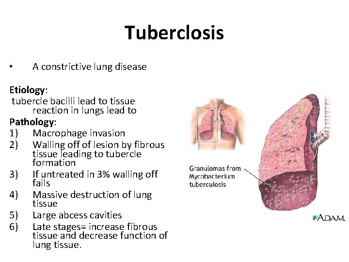 Tuberclosis • A constrictive lung disease Etiology: tubercle bacilli lead to tissue reaction in