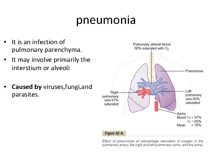 pneumonia • It is an infection of pulmonary parenchyma. • It may involve primarily