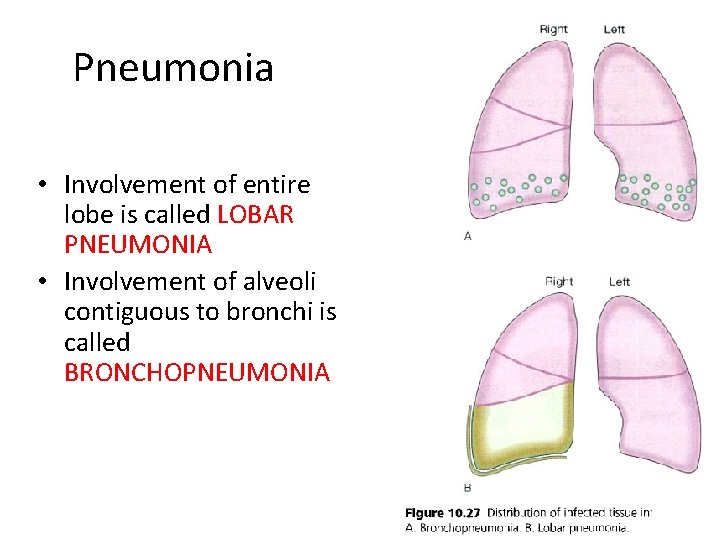 Pneumonia • Involvement of entire lobe is called LOBAR PNEUMONIA • Involvement of alveoli