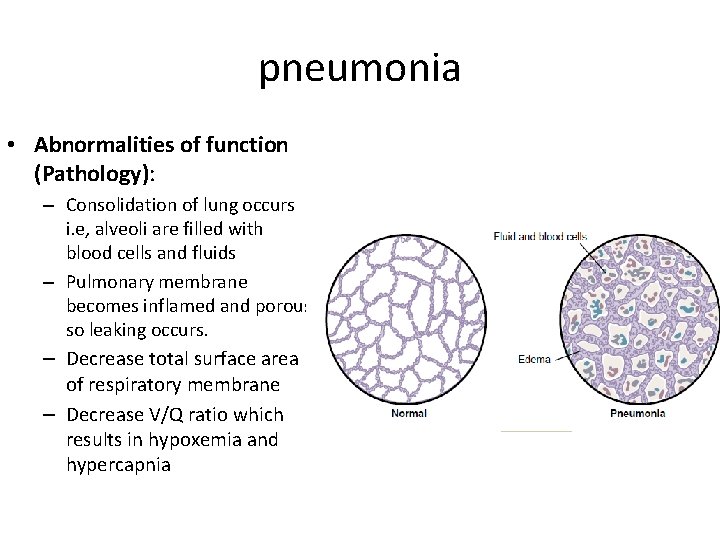 pneumonia • Abnormalities of function (Pathology): – Consolidation of lung occurs i. e, alveoli