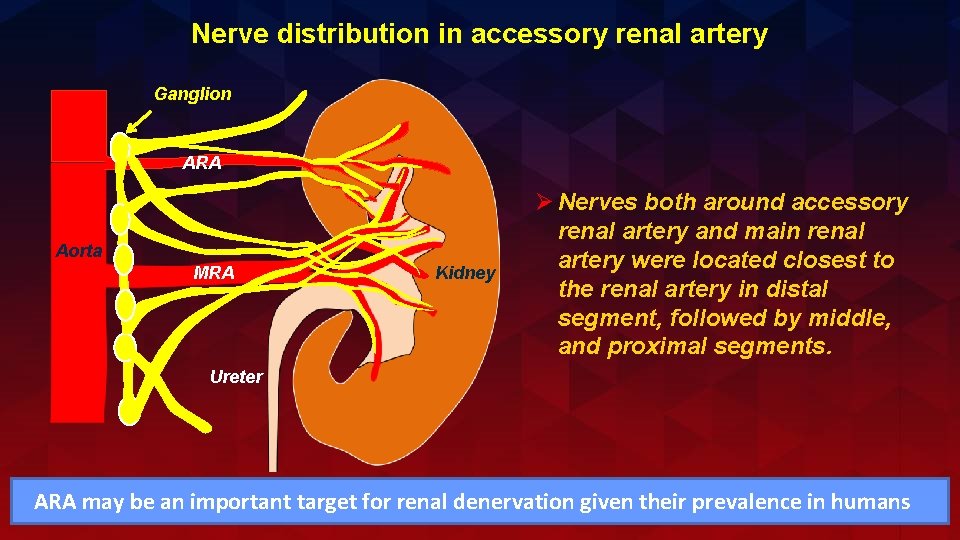 Nerve distribution in accessory renal artery Ganglion ARA Aorta MRA Kidney Ø Nerves both