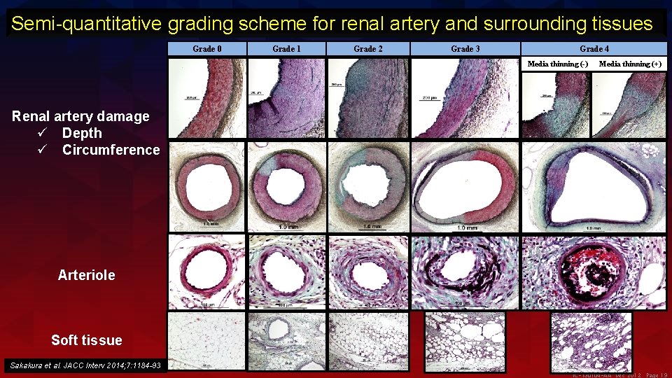 Semi-quantitative grading scheme for renal artery and surrounding tissues Grade 0 Grade 1 Grade