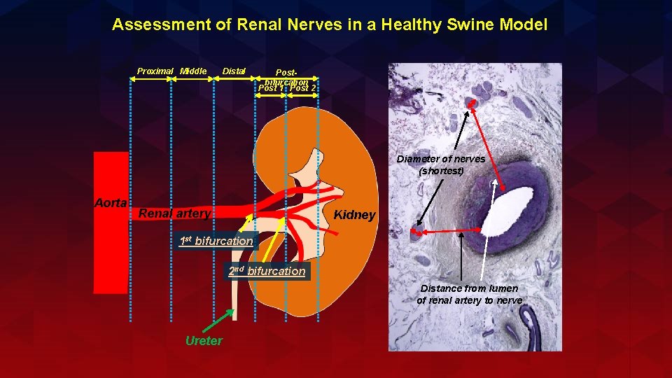 Assessment of Renal Nerves in a Healthy Swine Model Proximal Middle Distal Postbifurcation Post