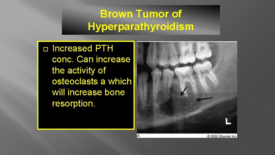 Brown Tumor of Hyperparathyroidism Increased PTH conc. Can increase the activity of osteoclasts a