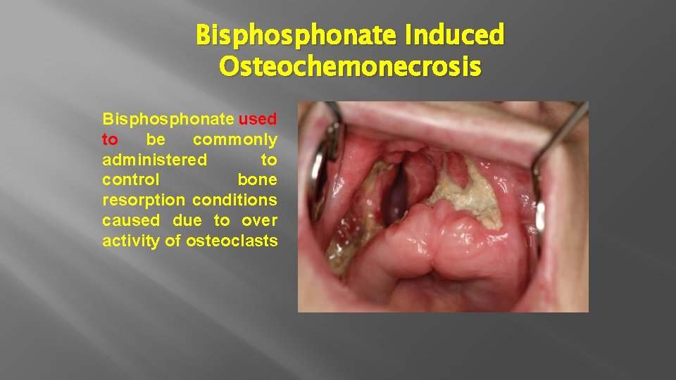 Bisphonate Induced Osteochemonecrosis Bisphonate used to be commonly administered to control bone resorption conditions