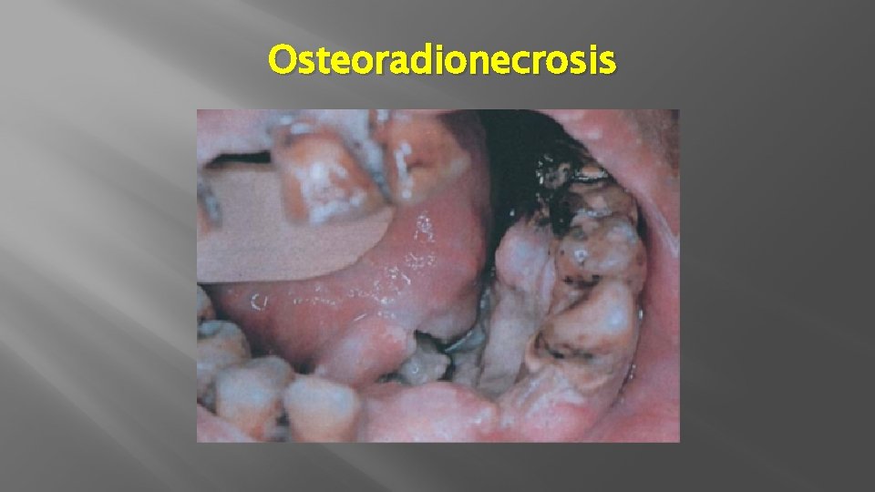 Osteoradionecrosis 