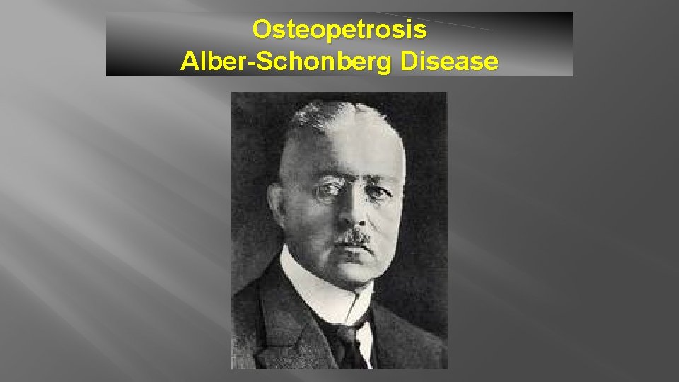 Osteopetrosis Alber-Schonberg Disease 