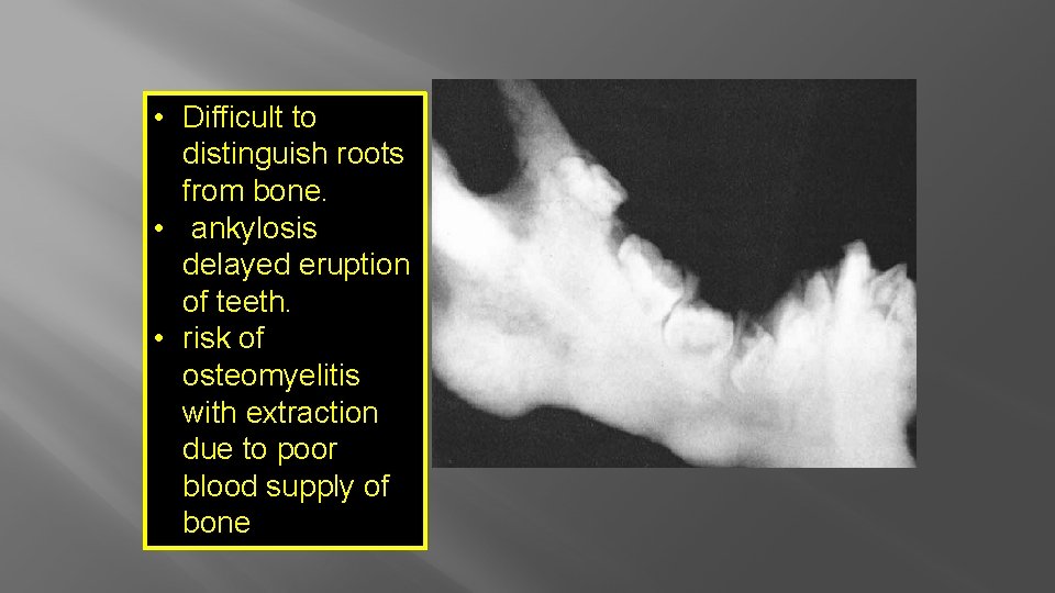  • Difficult to distinguish roots from bone. • ankylosis delayed eruption of teeth.