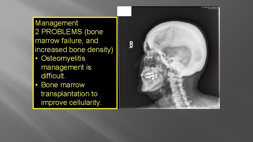 Management 2 PROBLEMS (bone marrow failure, and increased bone density) • Osteomyelitis management is