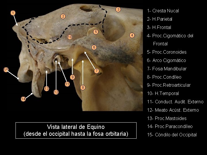 3 1 1 - Cresta Nucal 2 2 - H. Parietal 3 - H.