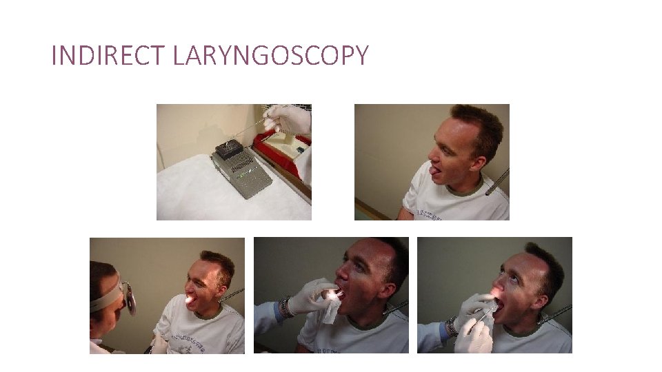 Anatomy of the larynx and benign lesions of