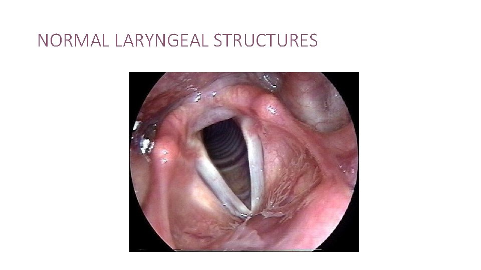 NORMAL LARYNGEAL STRUCTURES 