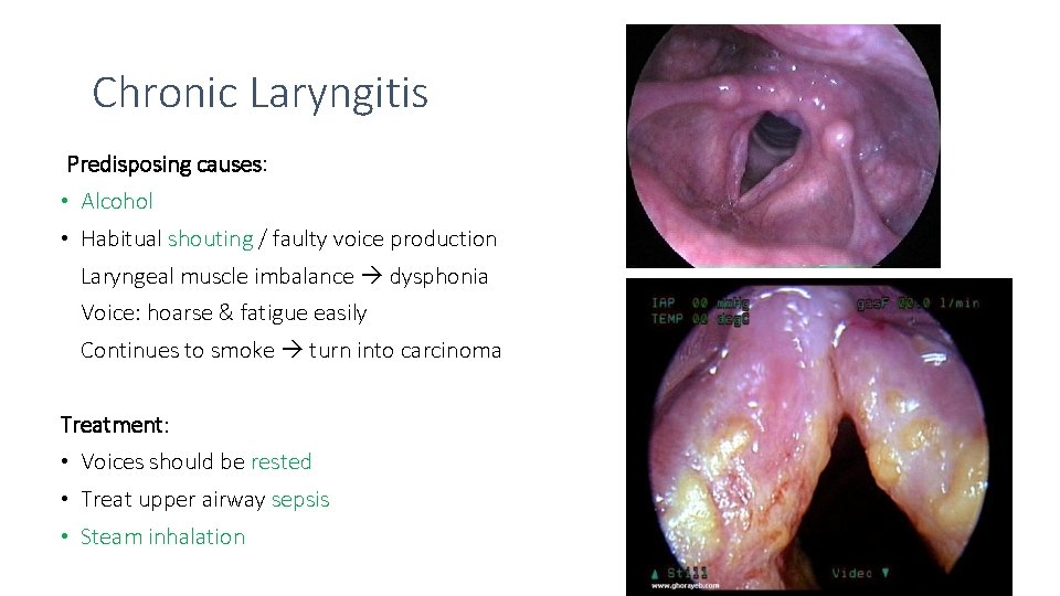 Chronic Laryngitis Predisposing causes: • Alcohol • Habitual shouting / faulty voice production Laryngeal
