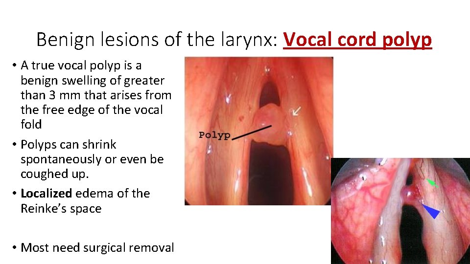 Benign lesions of the larynx: Vocal cord polyp • A true vocal polyp is