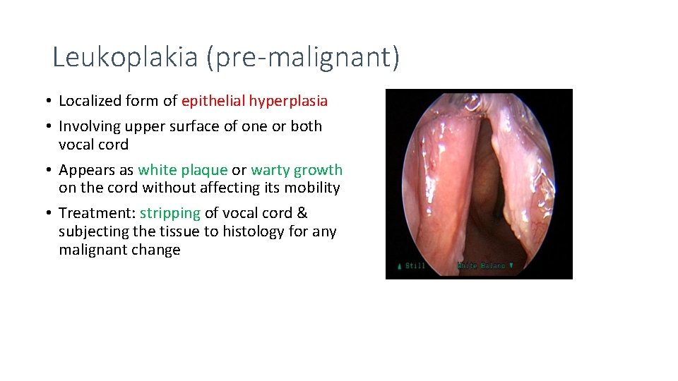 Leukoplakia (pre-malignant) • Localized form of epithelial hyperplasia • Involving upper surface of one