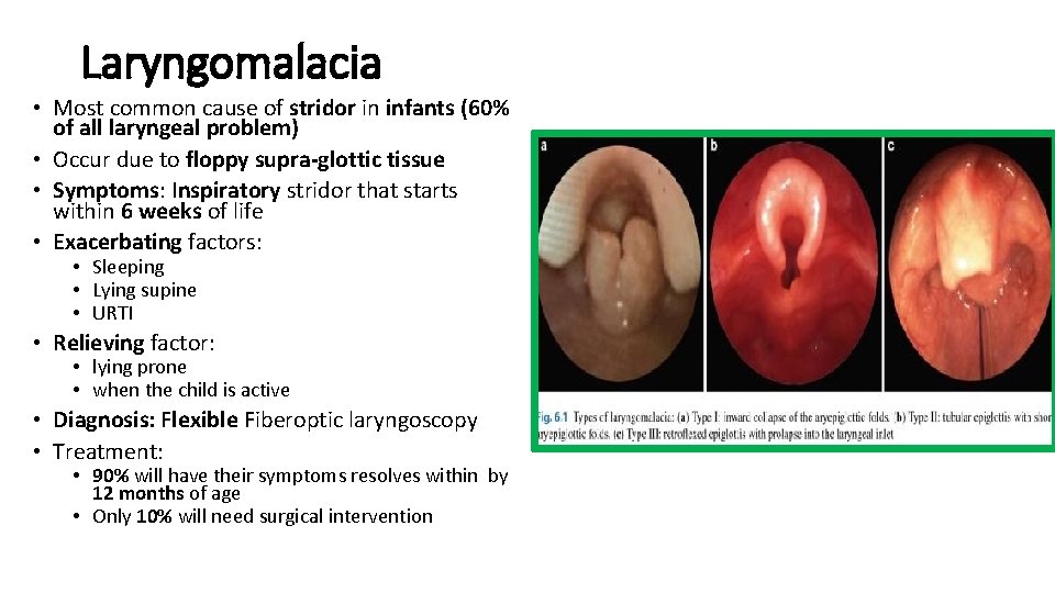 Laryngomalacia • Most common cause of stridor in infants (60% of all laryngeal problem)