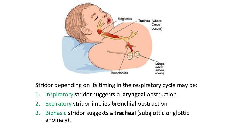 Stridor depending on its timing in the respiratory cycle may be: 1. Inspiratory stridor