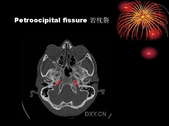 Petroocipital fissure 岩枕裂 