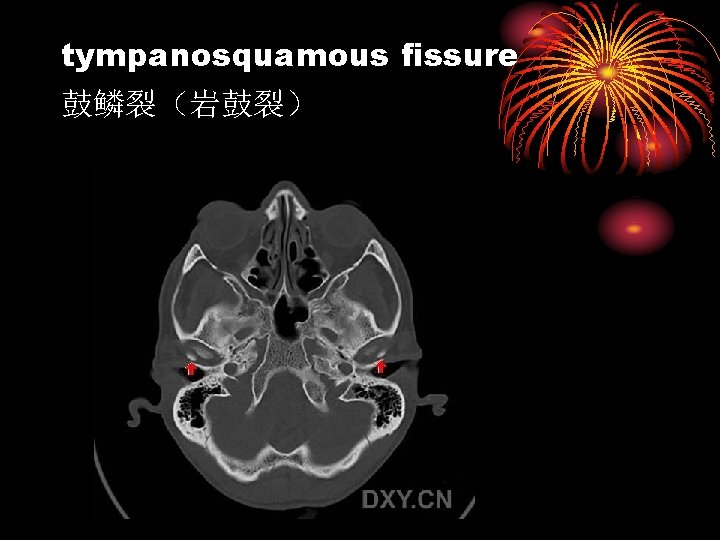 tympanosquamous fissure 鼓鳞裂（岩鼓裂） 