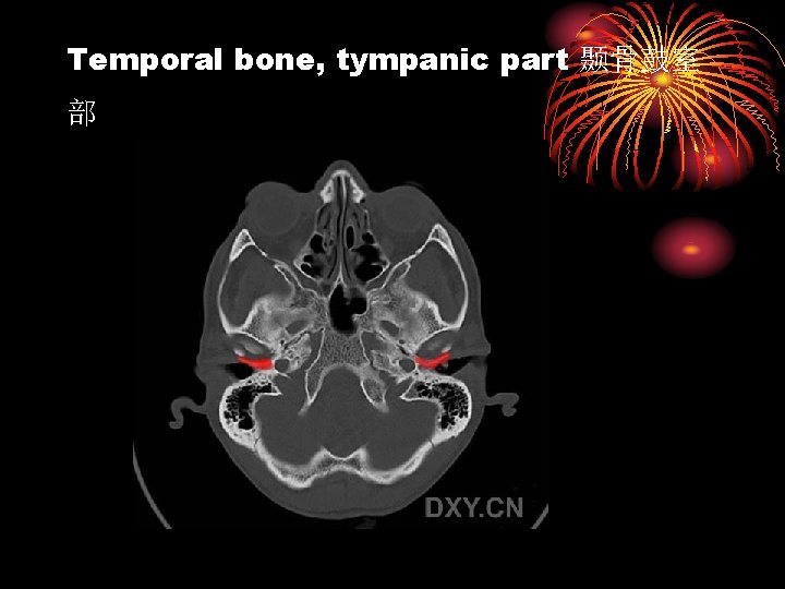 Temporal bone, tympanic part 颞骨鼓室 部 