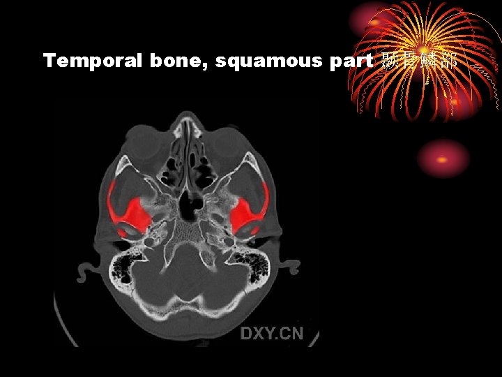 Temporal bone, squamous part 颞骨鳞部 