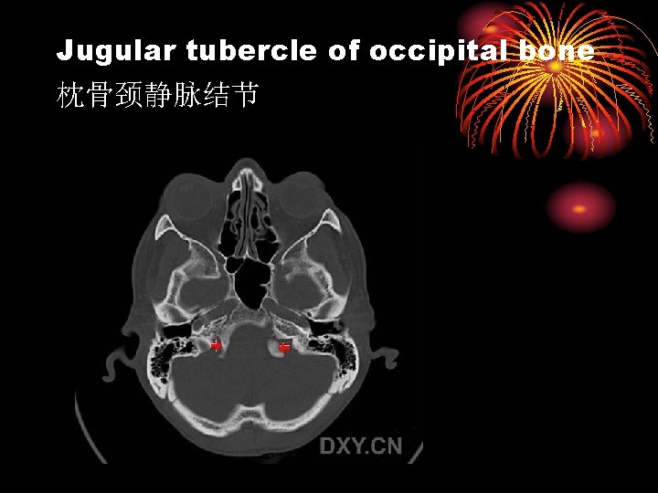 Jugular tubercle of occipital bone 枕骨颈静脉结节 