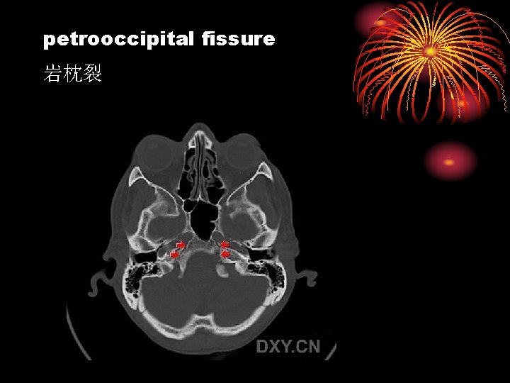 petrooccipital fissure 岩枕裂 