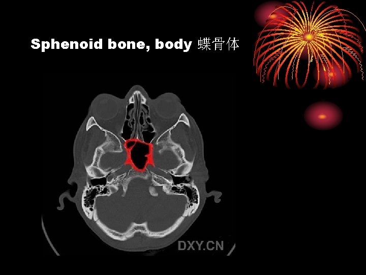 Sphenoid bone, body 蝶骨体 