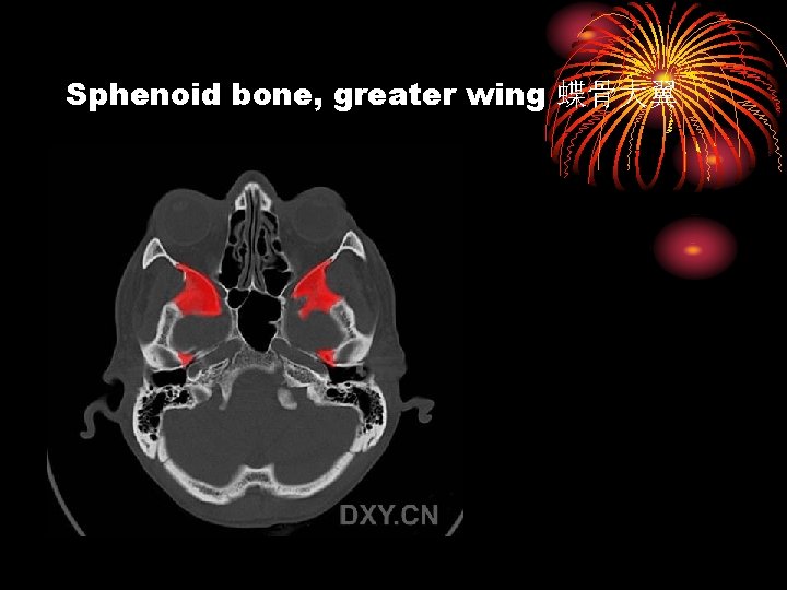 Sphenoid bone, greater wing 蝶骨大翼 