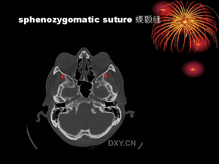 sphenozygomatic suture 蝶颧缝 