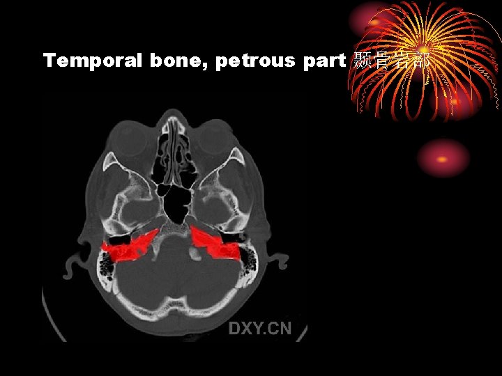 Temporal bone, petrous part 颞骨岩部 