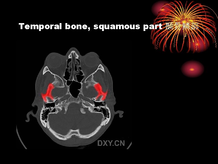 Temporal bone, squamous part 颞骨鳞部 