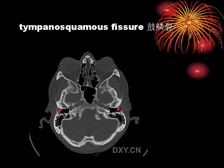 tympanosquamous fissure 鼓鳞裂 
