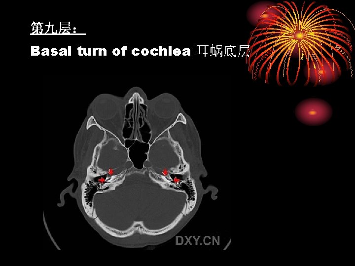 第九层： Basal turn of cochlea 耳蜗底层 