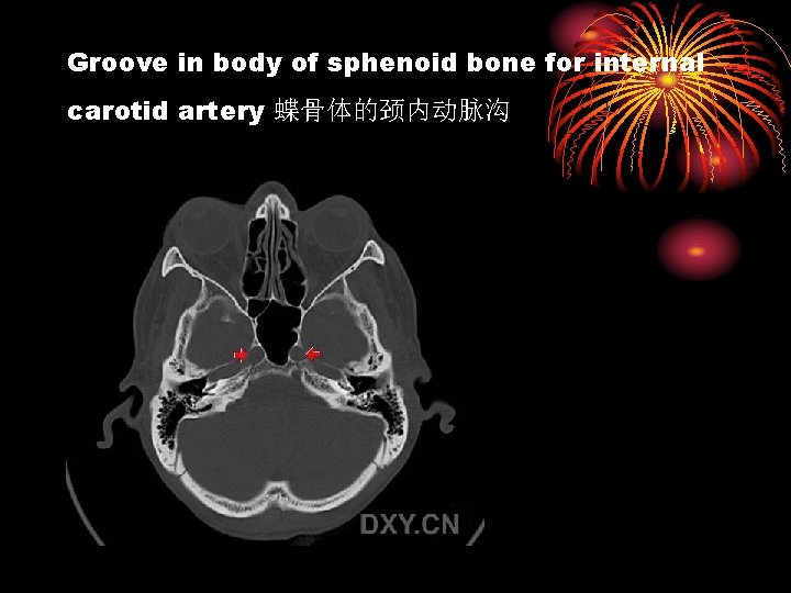 Groove in body of sphenoid bone for internal carotid artery 蝶骨体的颈内动脉沟 