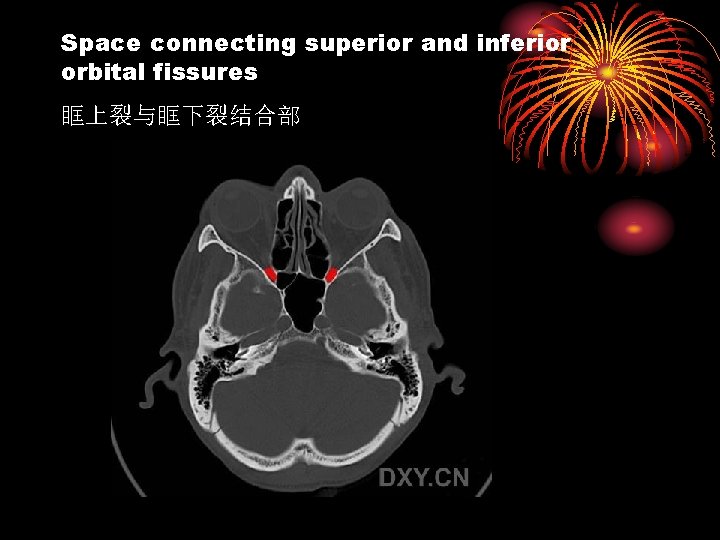 Space connecting superior and inferior orbital fissures 眶上裂与眶下裂结合部 