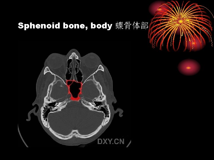 Sphenoid bone, body 蝶骨体部 