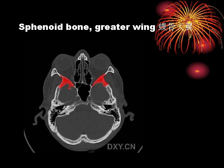 Sphenoid bone, greater wing 蝶骨大翼 