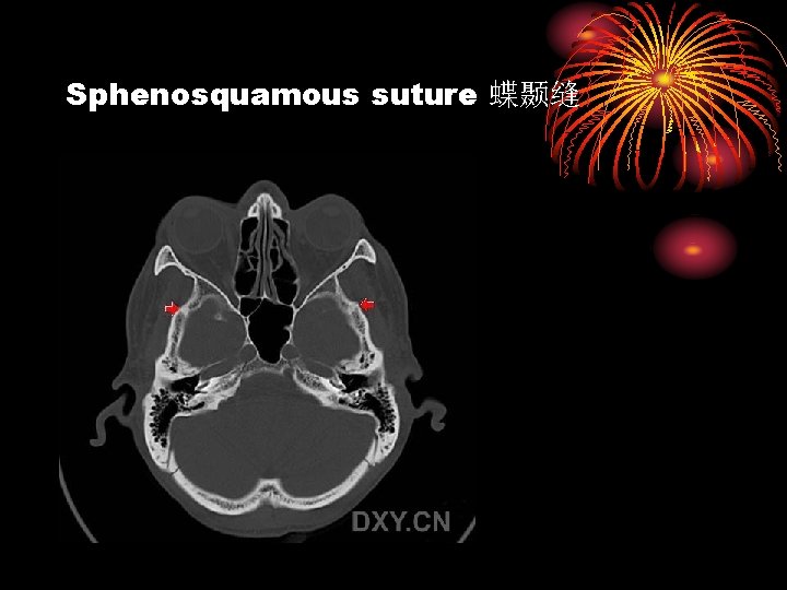 Sphenosquamous suture 蝶颞缝 