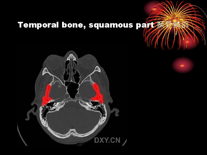 Temporal bone, squamous part 颞骨鳞部 