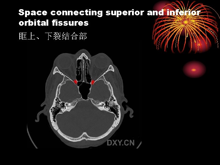 Space connecting superior and inferior orbital fissures 眶上、下裂结合部 