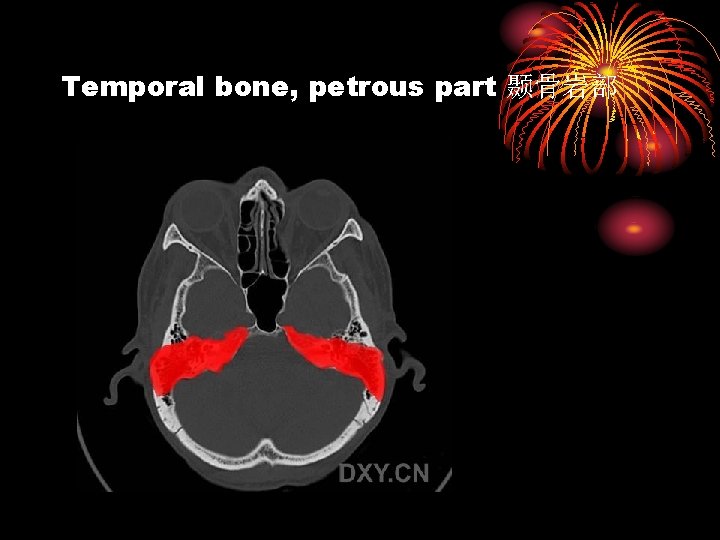 Temporal bone, petrous part 颞骨岩部 