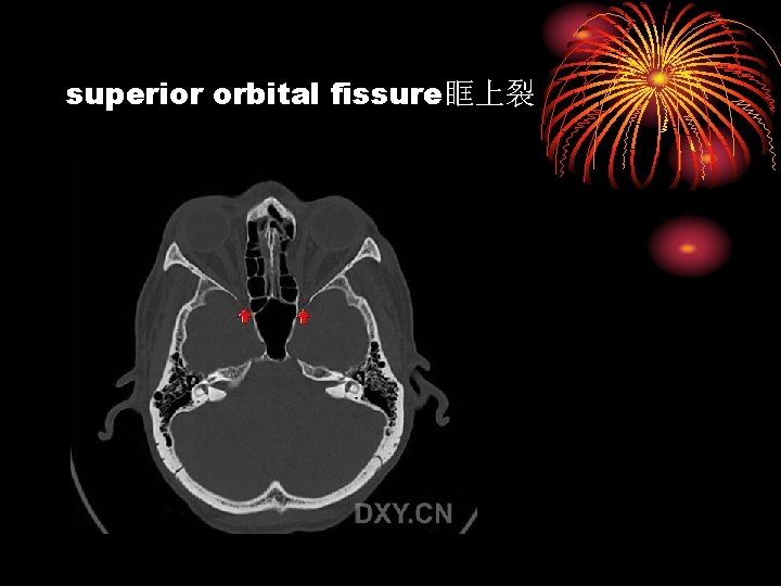 superior orbital fissure眶上裂 
