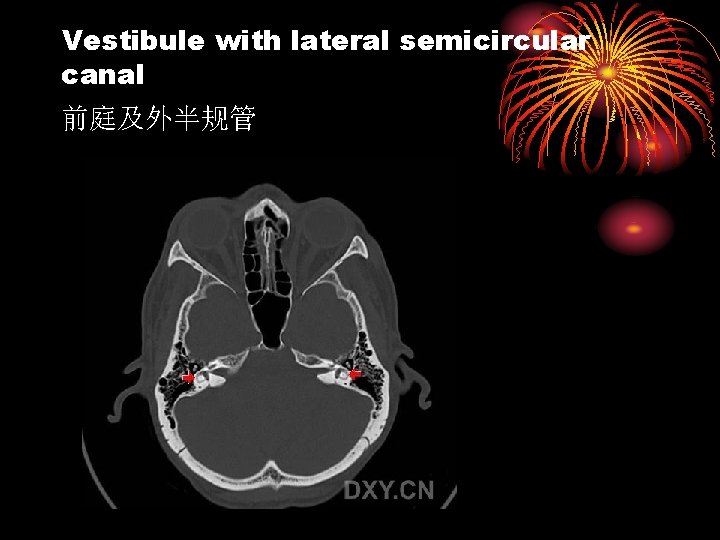 Vestibule with lateral semicircular canal 前庭及外半规管 