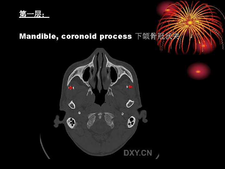 第一层： Mandible, coronoid process 下颌骨冠状突 