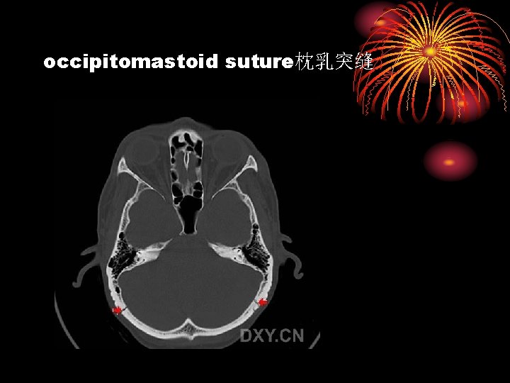 occipitomastoid suture枕乳突缝 