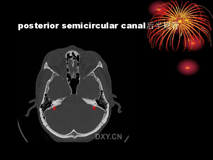 posterior semicircular canal后半规管 