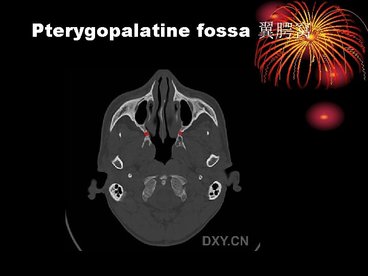 Pterygopalatine fossa 翼腭窝 
